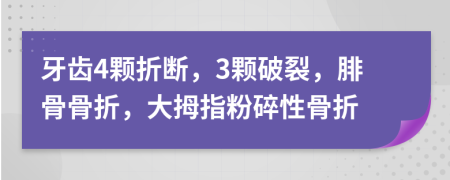 牙齿4颗折断，3颗破裂，腓骨骨折，大拇指粉碎性骨折